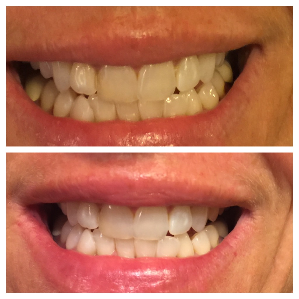 Before & After Photos Brooklyn, OH Today's Dentistry